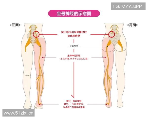 专家解读坐骨神经痛成因及治疗方法大多数患者可避免手术治疗 专家解读坐骨神经痛成因及治疗方法大多数患者可避免手术治疗